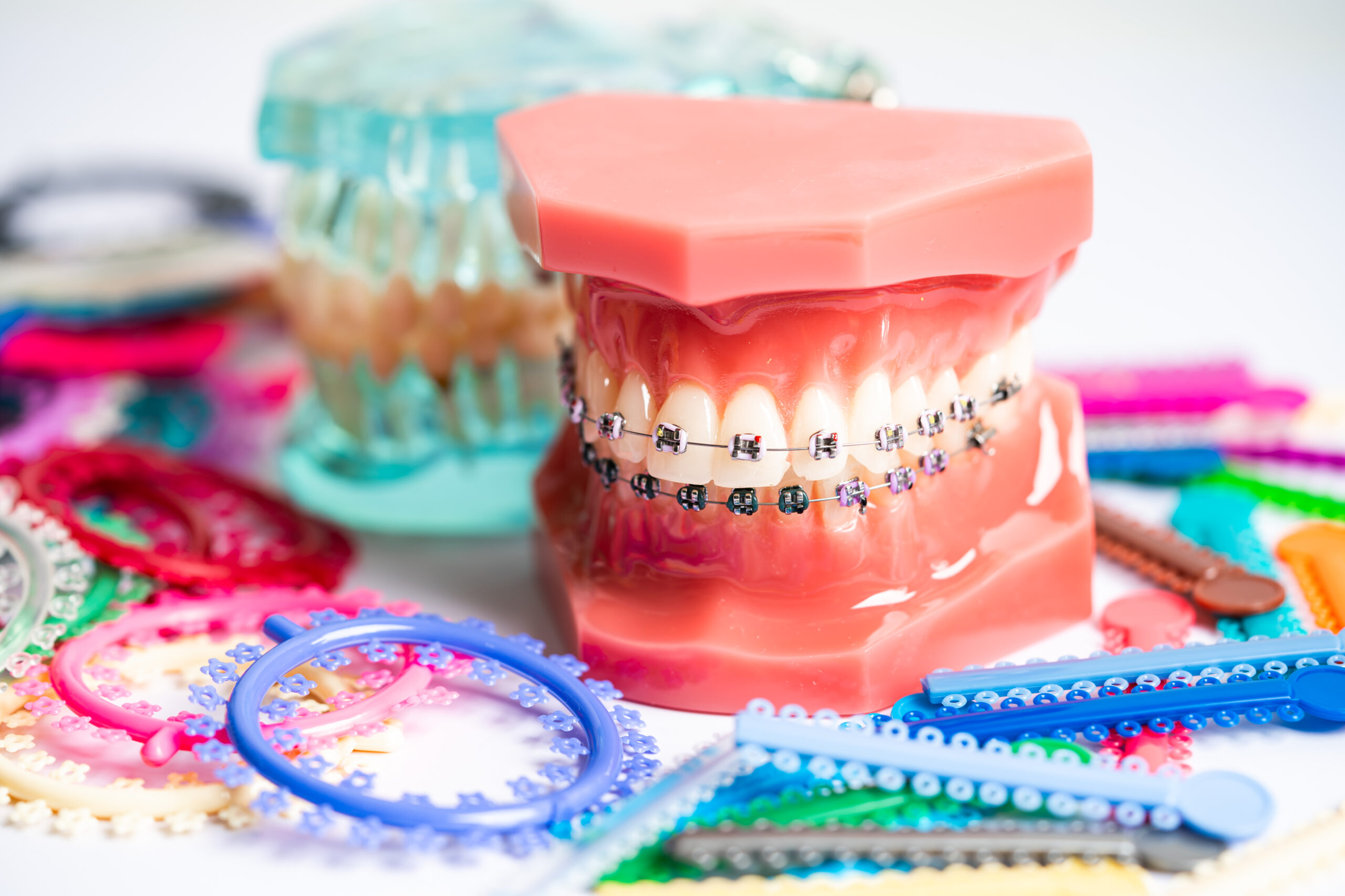 A photo of orthodontic metal braces, rubber bands, and ortho accessories